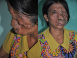 Woman with deformed face seeks help